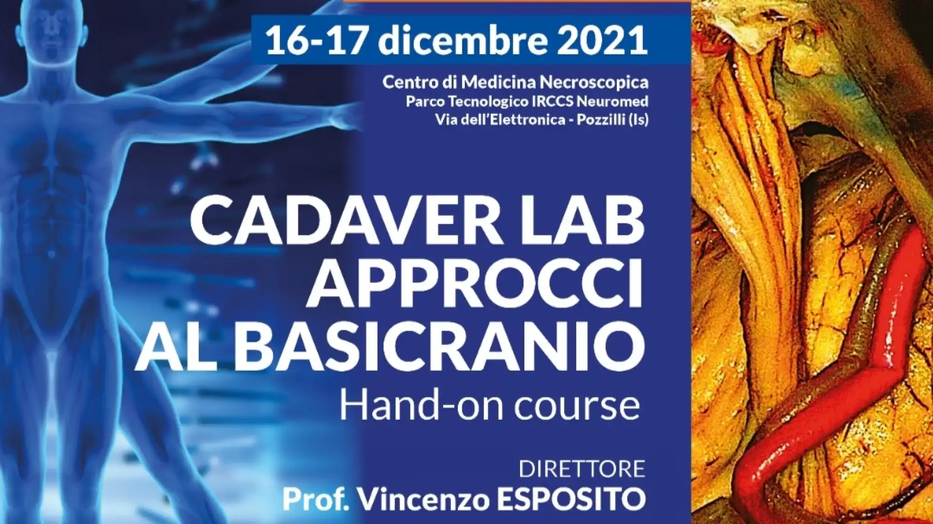 Tra scienza e abilità: la formazione dei giovani neurochirurghi. Il corso promosso dall'Ircss Neuromed