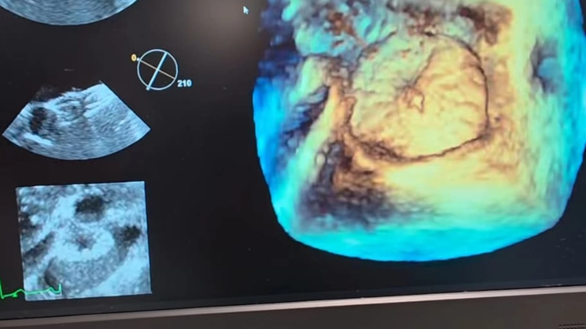 Cardiologia al San Timoteo di Termoli sempre più efficiente: effettuate procedure con tecniche mini-invasive