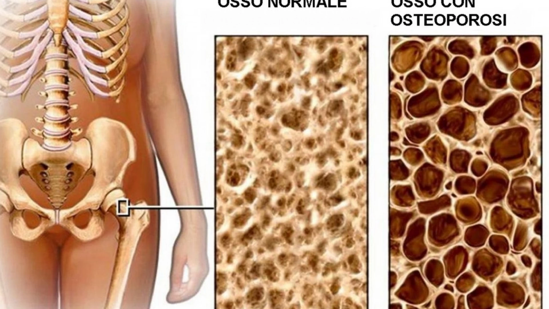 Osteoporosi: screening gratuito della popolazione a Fornelli promosso da Villa Irene Senior House e Centro Medico Vita Salus